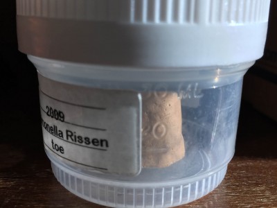 One case had Salmonella cultured from an amputated toe; a replica exists in the museum.
